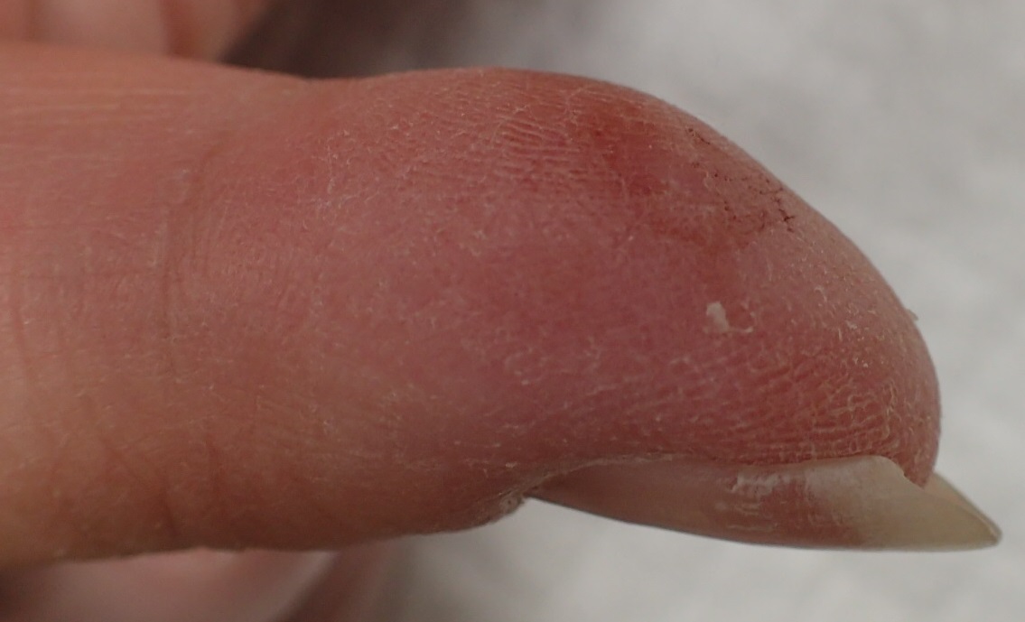 粉瘤（アテローム） | こおりたひろ整形形成外科クリニック - 痛みの少ない粉瘤治療で多数の実績｜大阪｜