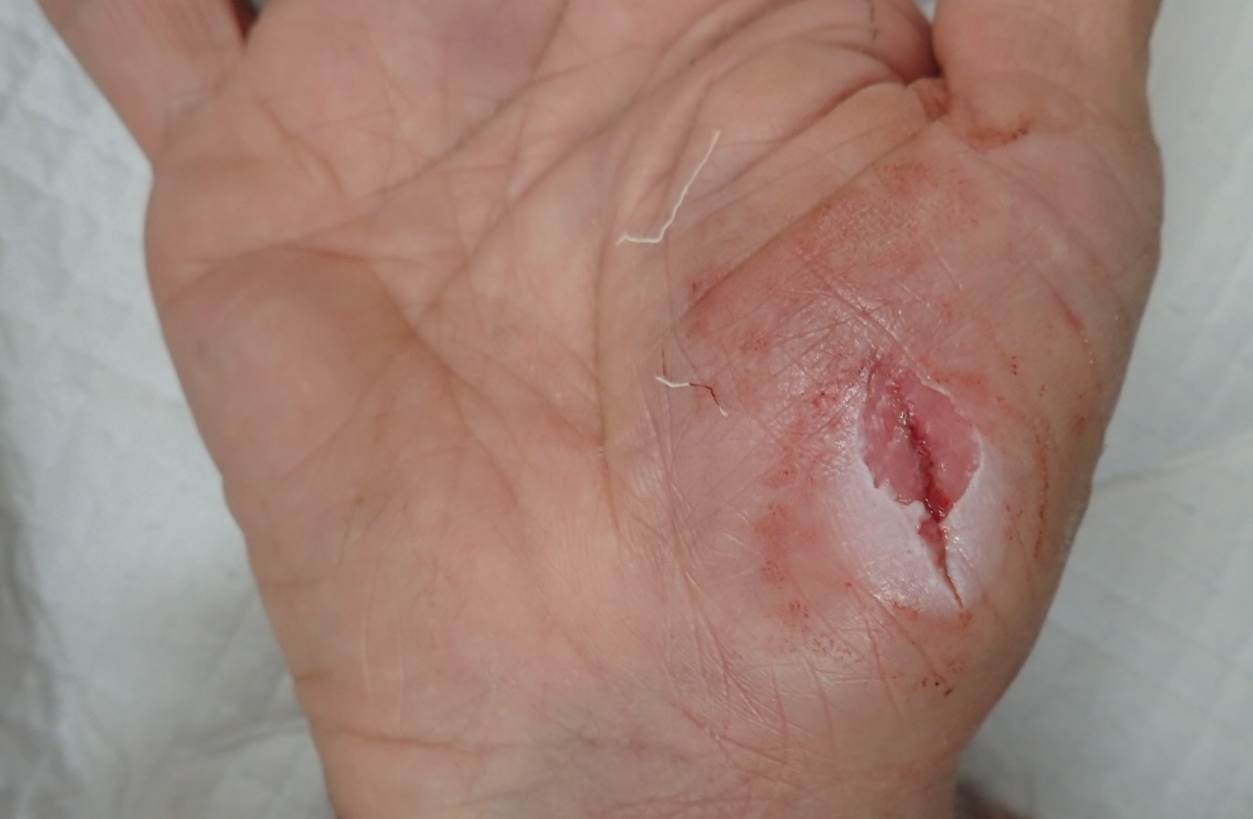 粉瘤（アテローム） | こおりたひろ整形形成外科クリニック - 痛みの少ない粉瘤治療で多数の実績｜大阪｜