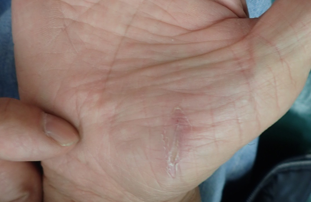 粉瘤（アテローム） | こおりたひろ整形形成外科クリニック - 痛みの少ない粉瘤治療で多数の実績｜大阪｜