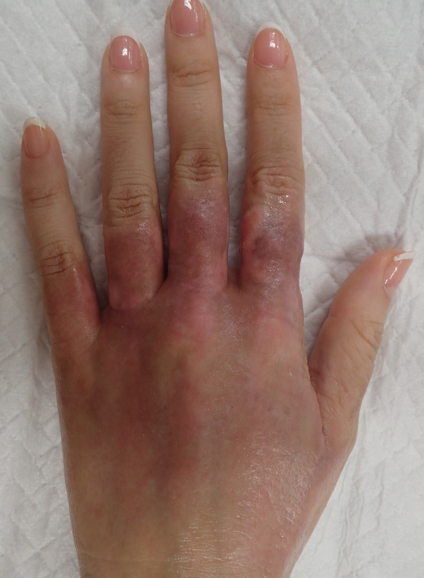 粉瘤（アテローム） | こおりたひろ整形形成外科クリニック - 痛みの少ない粉瘤治療で多数の実績｜大阪｜