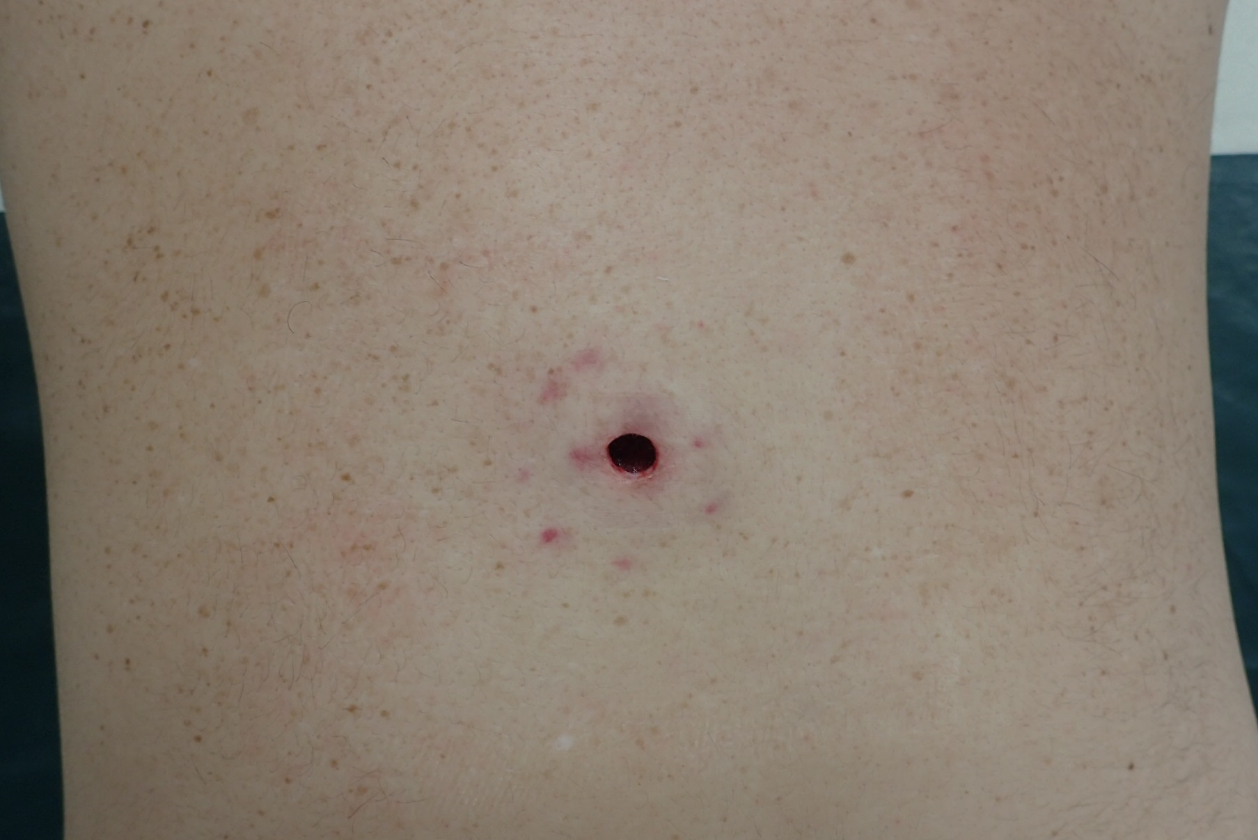 粉瘤（アテローム） | こおりたひろ整形形成外科クリニック - 痛みの少ない粉瘤治療で多数の実績｜大阪｜