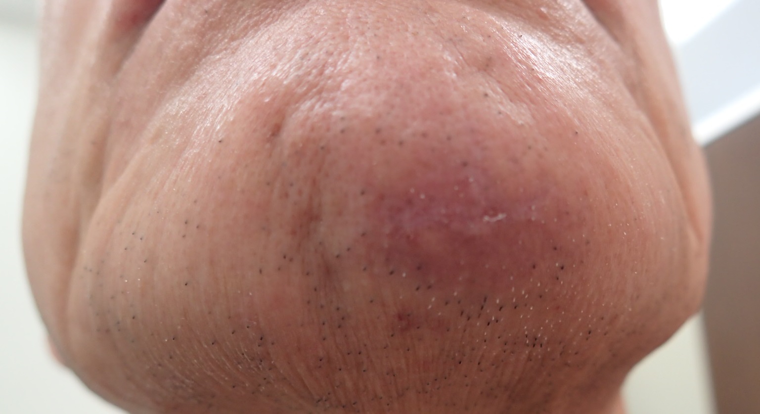 粉瘤（アテローム） | こおりたひろ整形形成外科クリニック - 痛みの少ない粉瘤治療で多数の実績｜大阪｜