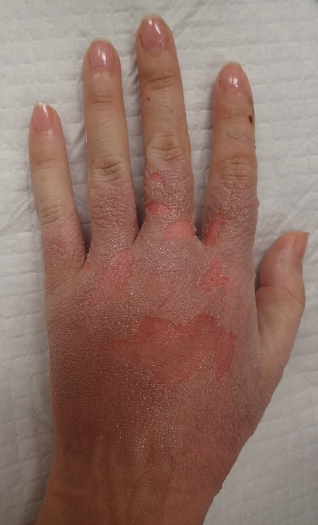 粉瘤（アテローム） | こおりたひろ整形形成外科クリニック - 痛みの少ない粉瘤治療で多数の実績｜大阪｜