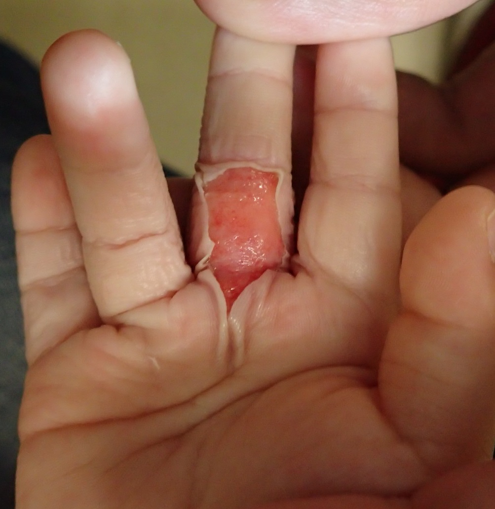 粉瘤（アテローム） | こおりたひろ整形形成外科クリニック - 痛みの少ない粉瘤治療で多数の実績｜大阪｜