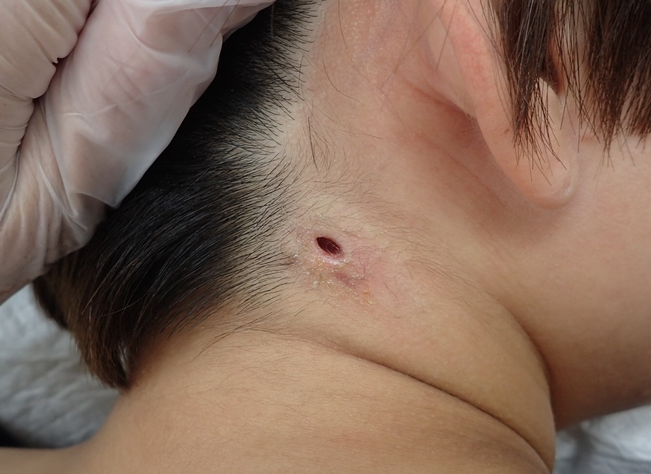 粉瘤（アテローム） | こおりたひろ整形形成外科クリニック - 痛みの少ない粉瘤治療で多数の実績｜大阪｜