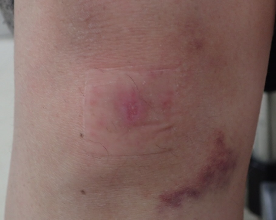 粉瘤（アテローム） | こおりたひろ整形形成外科クリニック - 痛みの少ない粉瘤治療で多数の実績｜大阪｜