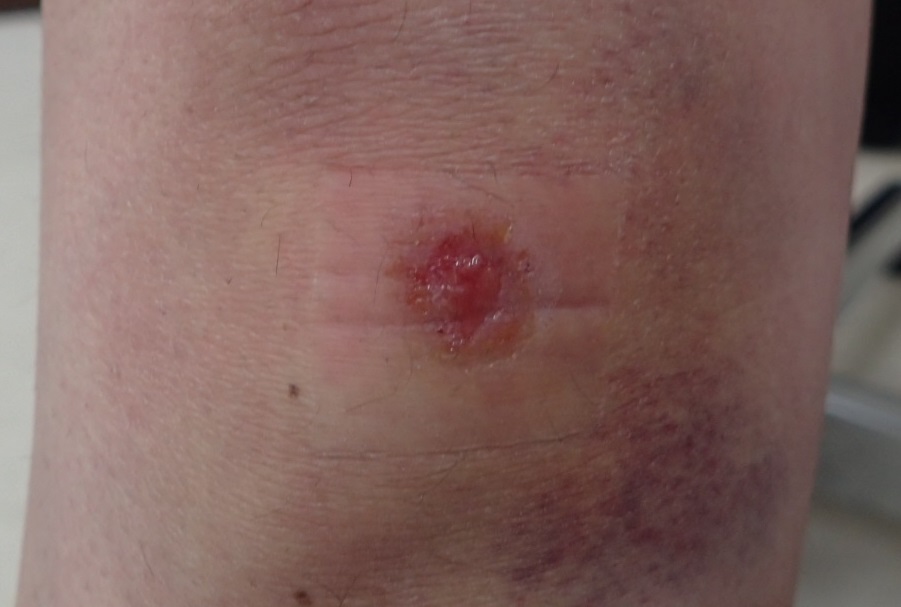 粉瘤（アテローム） | こおりたひろ整形形成外科クリニック - 痛みの少ない粉瘤治療で多数の実績｜大阪｜