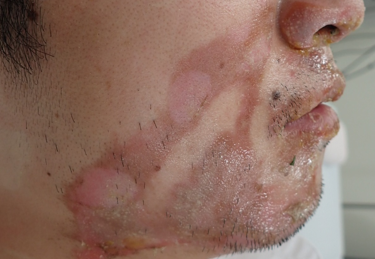 粉瘤（アテローム） | こおりたひろ整形形成外科クリニック - 痛みの少ない粉瘤治療で多数の実績｜大阪｜