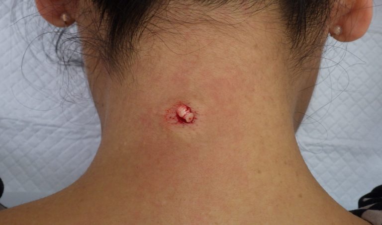 胸のおできの原因