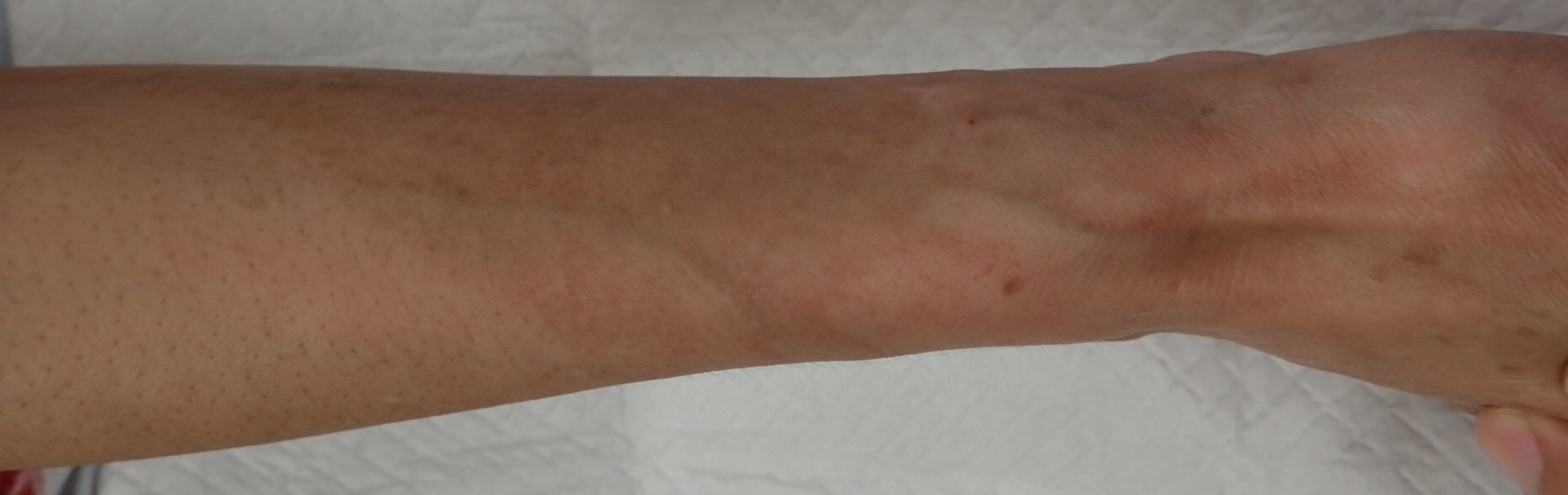 粉瘤（アテローム） | こおりたひろ整形形成外科クリニック - 痛みの少ない粉瘤治療で多数の実績｜大阪｜