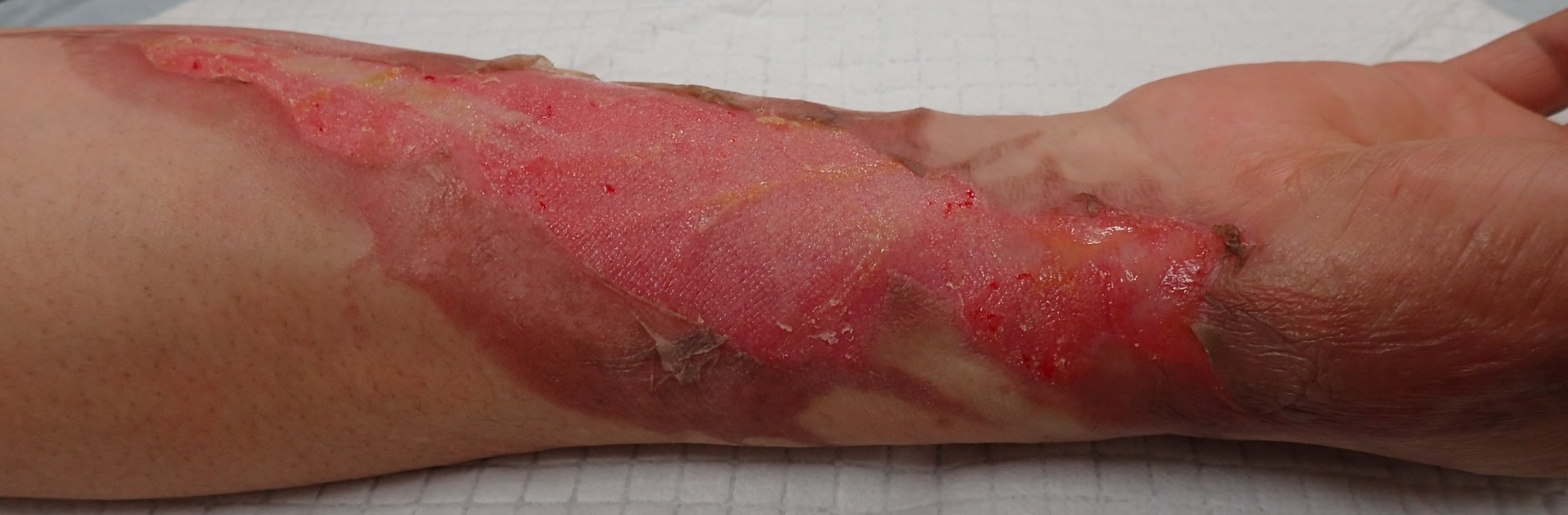 粉瘤（アテローム） | こおりたひろ整形形成外科クリニック - 痛みの少ない粉瘤治療で多数の実績｜大阪｜