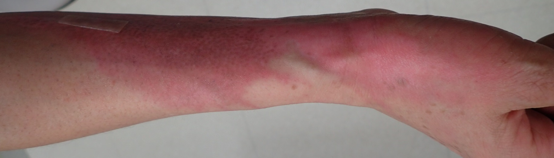 粉瘤（アテローム） | こおりたひろ整形形成外科クリニック - 痛みの少ない粉瘤治療で多数の実績｜大阪｜