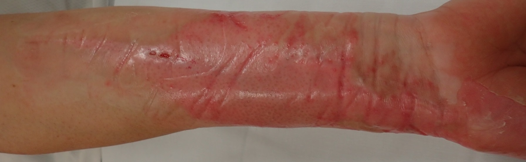 粉瘤（アテローム） | こおりたひろ整形形成外科クリニック - 痛みの少ない粉瘤治療で多数の実績｜大阪｜