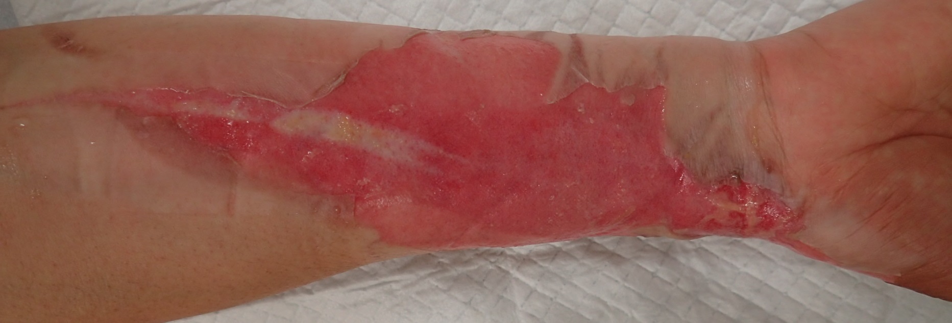 粉瘤（アテローム） | こおりたひろ整形形成外科クリニック - 痛みの少ない粉瘤治療で多数の実績｜大阪｜