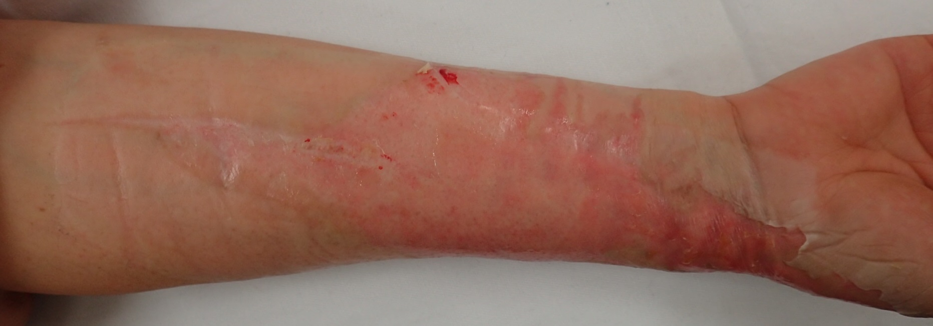 粉瘤（アテローム） | こおりたひろ整形形成外科クリニック - 痛みの少ない粉瘤治療で多数の実績｜大阪｜