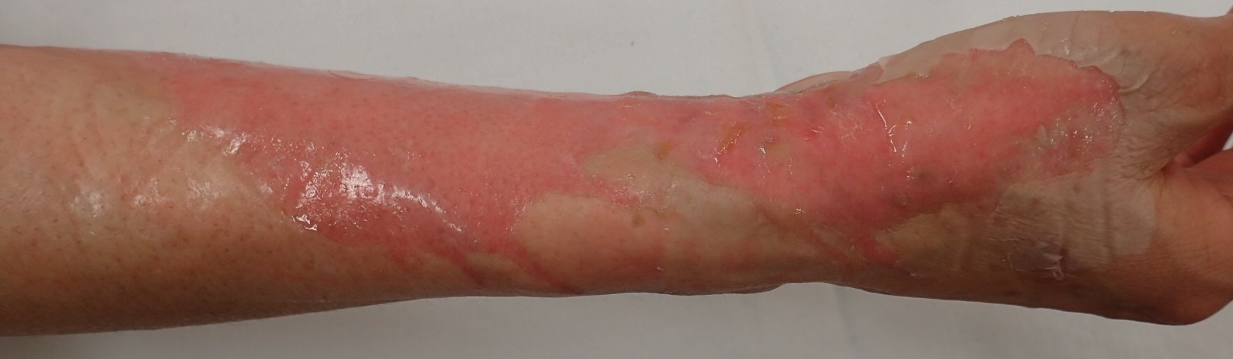 粉瘤（アテローム） | こおりたひろ整形形成外科クリニック - 痛みの少ない粉瘤治療で多数の実績｜大阪｜