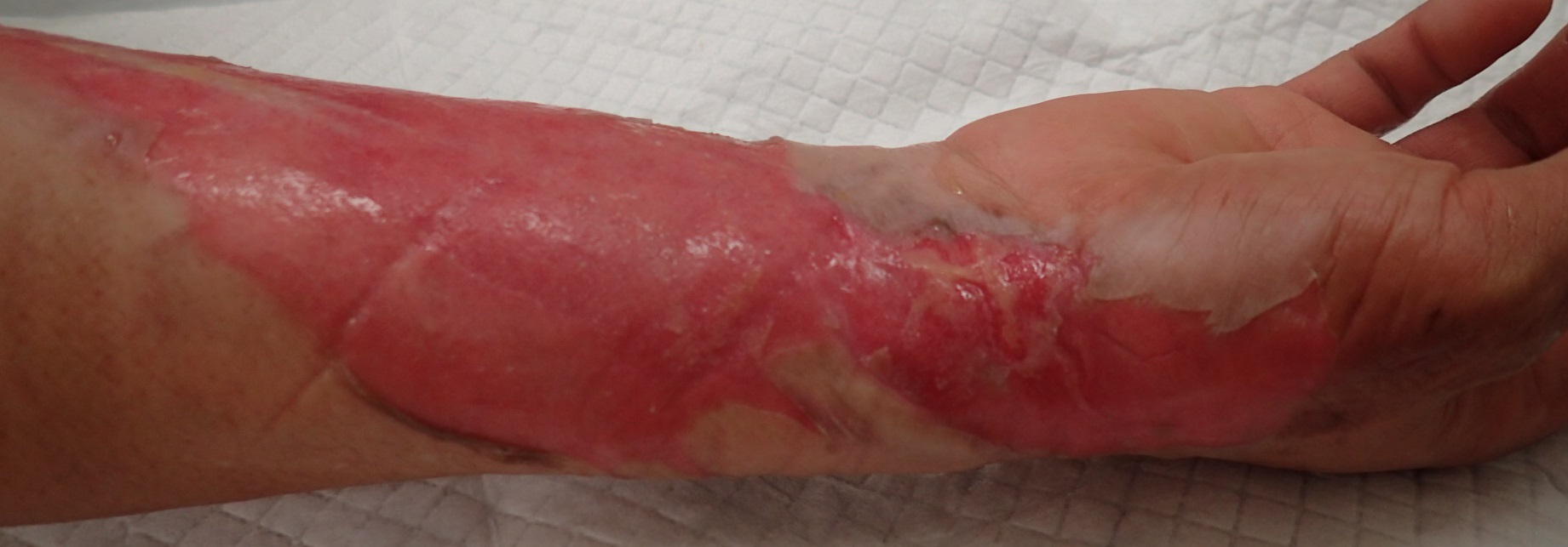 粉瘤（アテローム） | こおりたひろ整形形成外科クリニック - 痛みの少ない粉瘤治療で多数の実績｜大阪｜