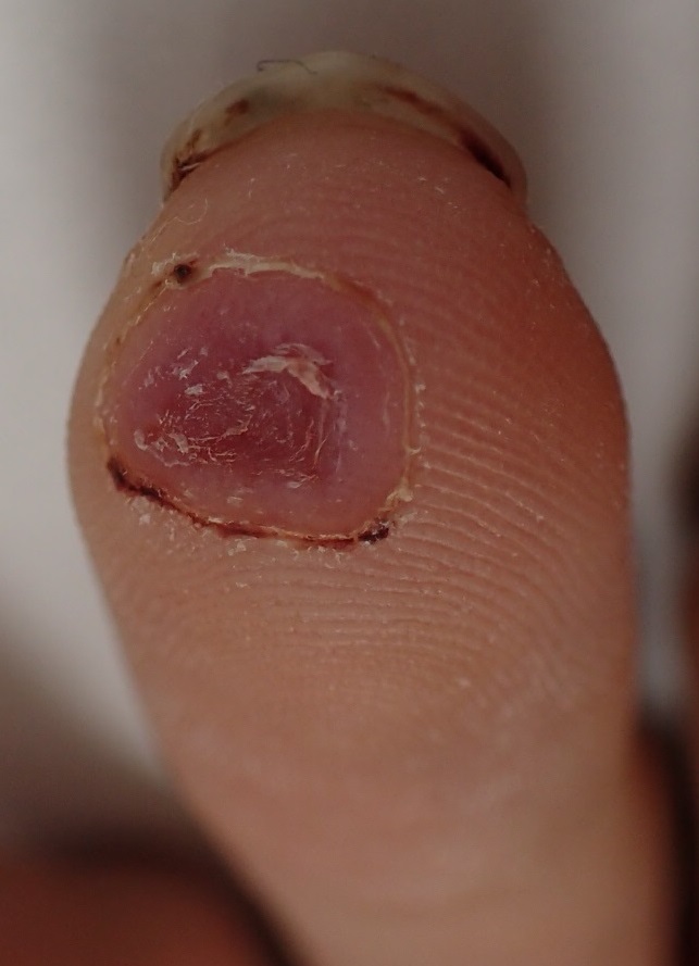 粉瘤（アテローム） | こおりたひろ整形形成外科クリニック - 痛みの少ない粉瘤治療で多数の実績｜大阪｜