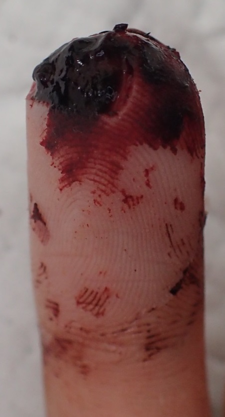 粉瘤（アテローム） | こおりたひろ整形形成外科クリニック - 痛みの少ない粉瘤治療で多数の実績｜大阪｜