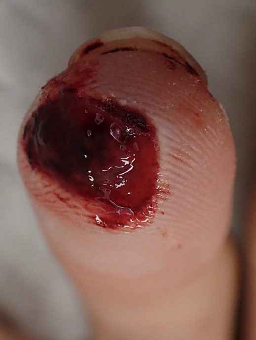 粉瘤（アテローム） | こおりたひろ整形形成外科クリニック - 痛みの少ない粉瘤治療で多数の実績｜大阪｜