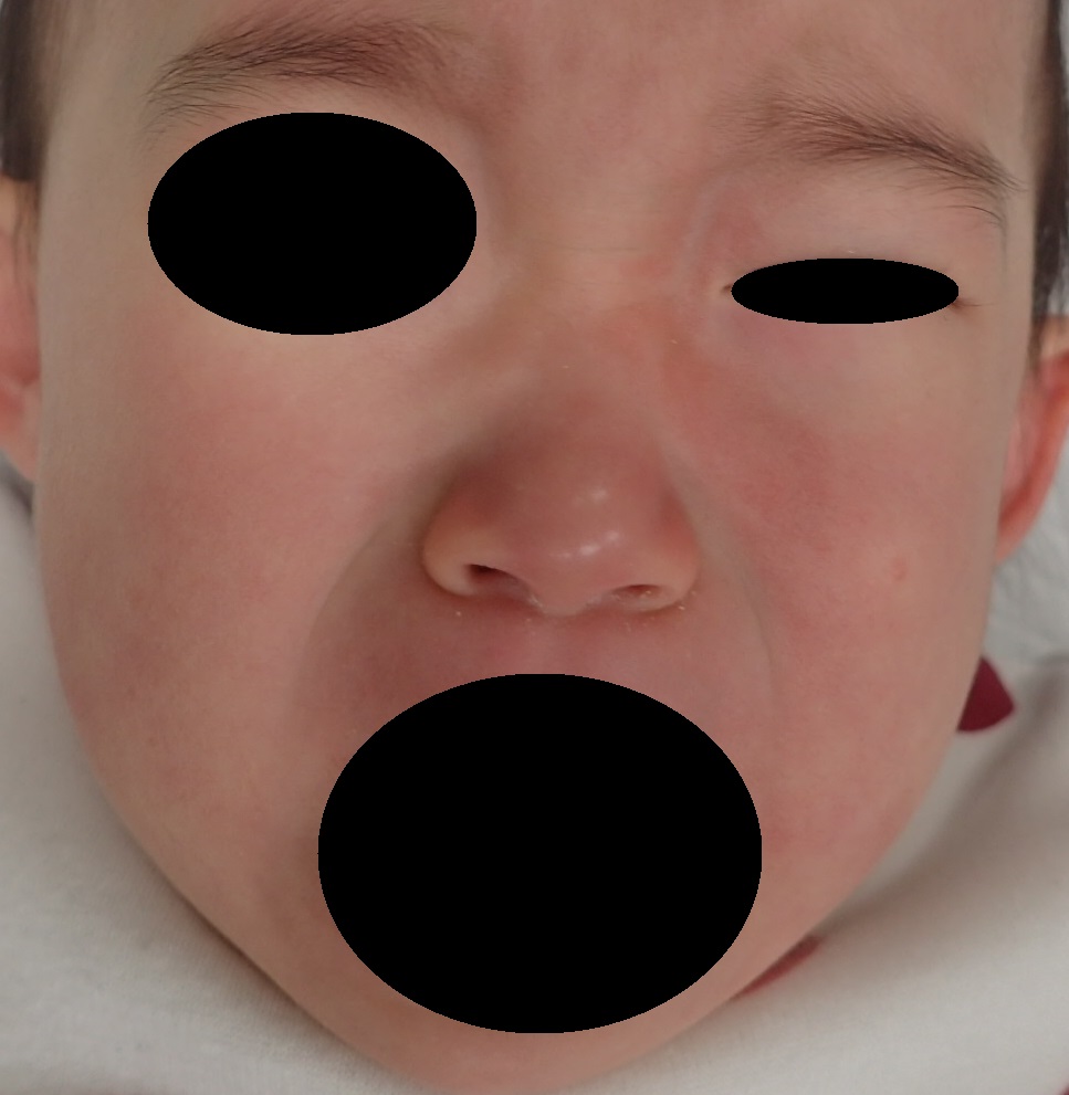 粉瘤（アテローム） | こおりたひろ整形形成外科クリニック - 痛みの少ない粉瘤治療で多数の実績｜大阪｜