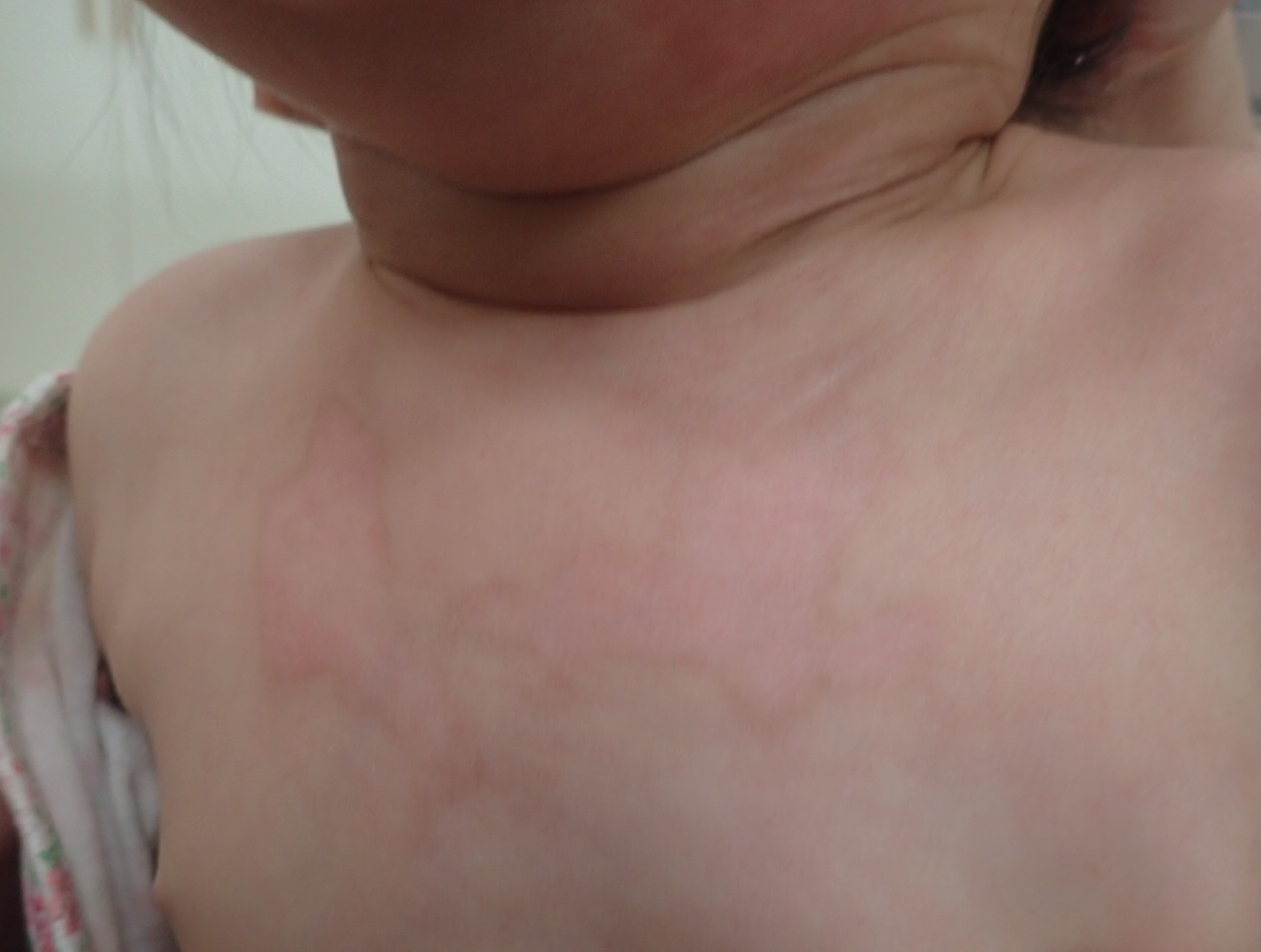 粉瘤（アテローム） | こおりたひろ整形形成外科クリニック - 痛みの少ない粉瘤治療で多数の実績｜大阪｜