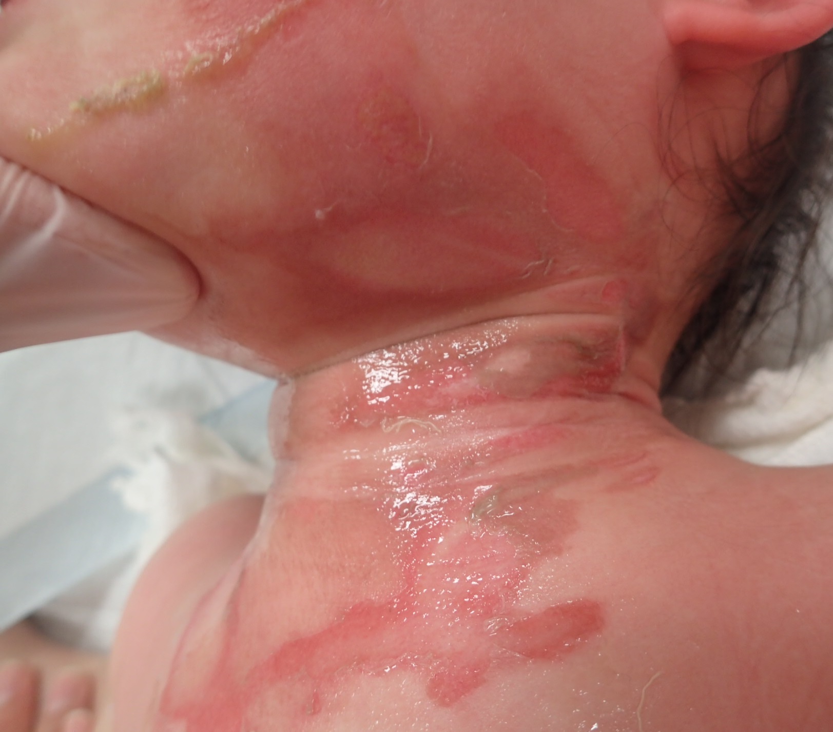 粉瘤（アテローム） | こおりたひろ整形形成外科クリニック - 痛みの少ない粉瘤治療で多数の実績｜大阪｜