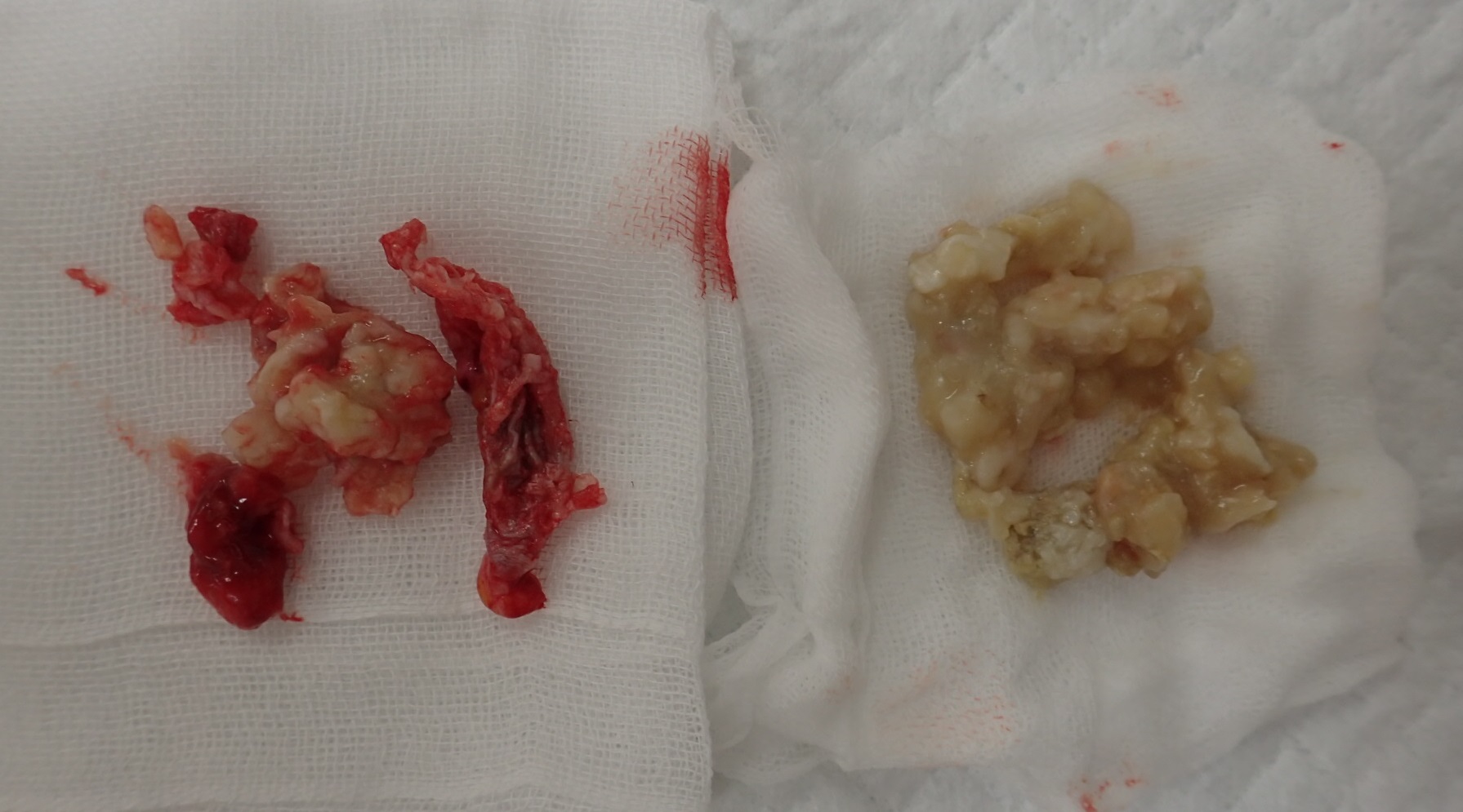 摘出された粉瘤(左被膜,右内容物)