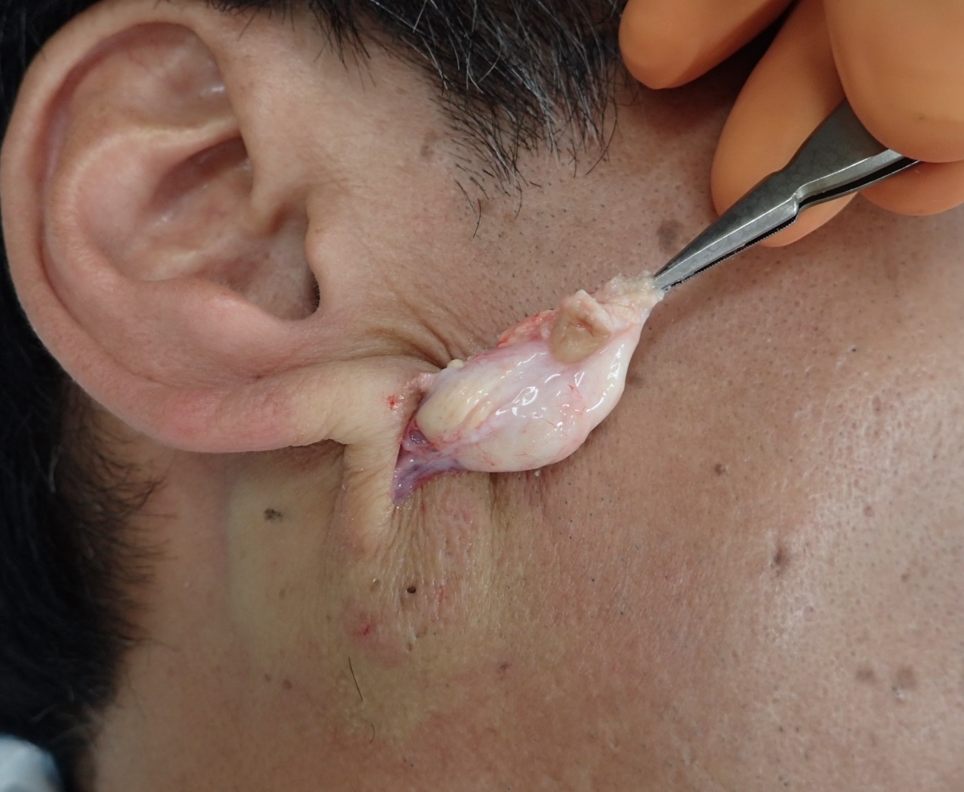 粉瘤（アテローム）耳の下（くりぬき法） - 粉瘤（アテローム） | こおりたひろ整形形成外科クリニック - 痛みの少ない粉瘤治療で多数の実績｜大阪｜