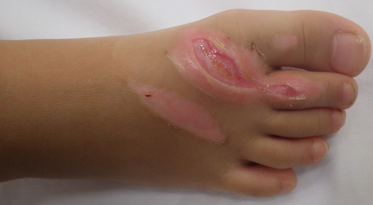 植皮が必要と言われた 3歳 足背の熱傷です。(湿潤療法) - 粉瘤