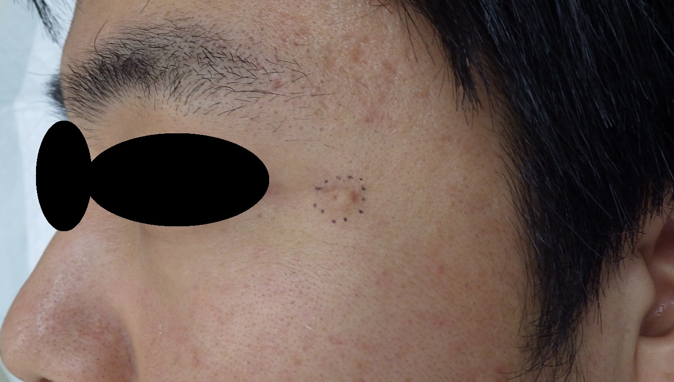 粉瘤 アテローム 目尻 くりぬき法 粉瘤 アテローム こおりたひろ整形形成外科クリニック 痛みの少ない粉瘤治療で多数の実績 大阪
