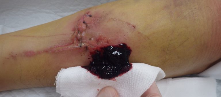 血腫除去中