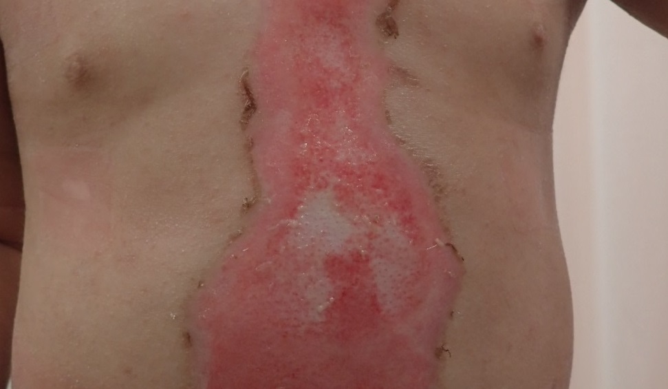 植皮が必要と言われた1歳 胸部の熱傷です。（湿潤療法） - 粉瘤