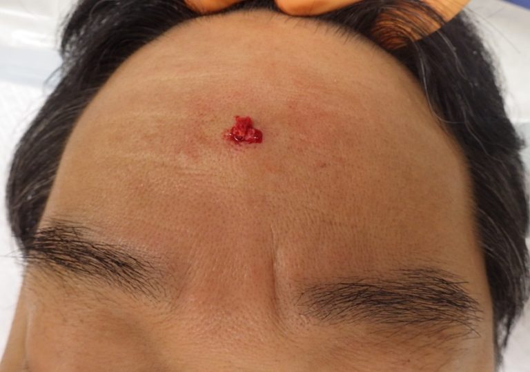11月12日(術中)