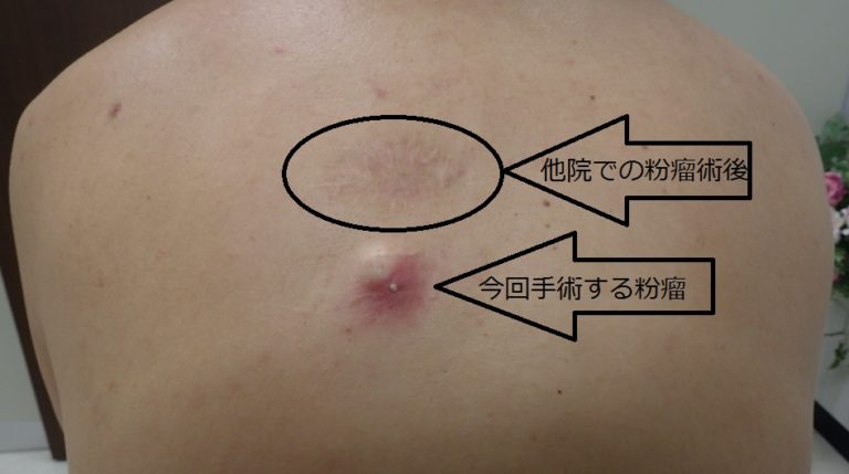 術前