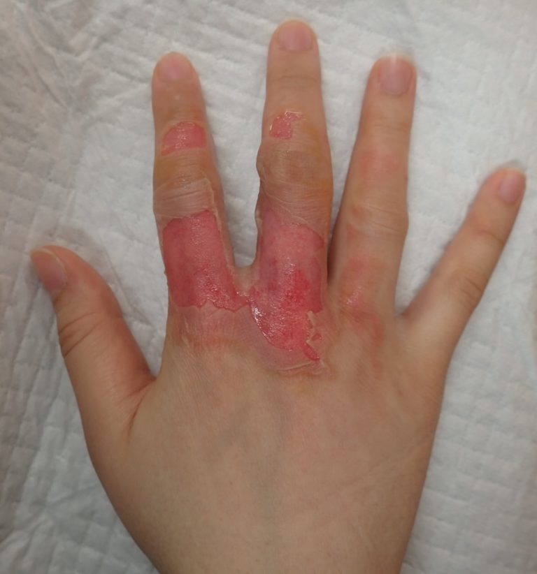 初診時(背側・水疱膜切除後)