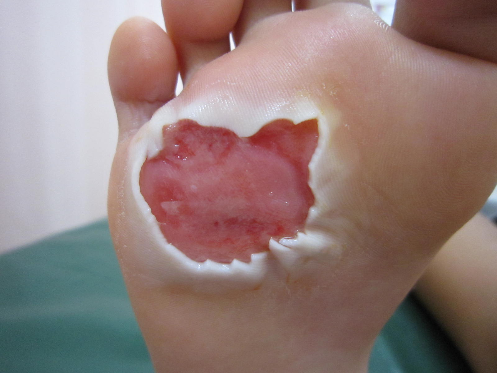 子供の足底の火傷です 湿潤療法 粉瘤 アテローム こおりたひろ整形形成外科クリニック 痛みの少ない粉瘤治療で多数の実績 大阪