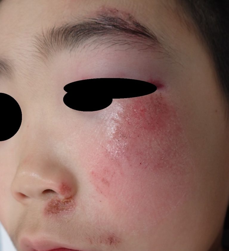 初診時(斜位)