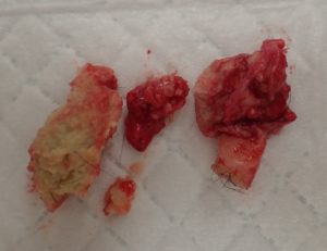 摘出された粉瘤(右被膜、左内容物)
