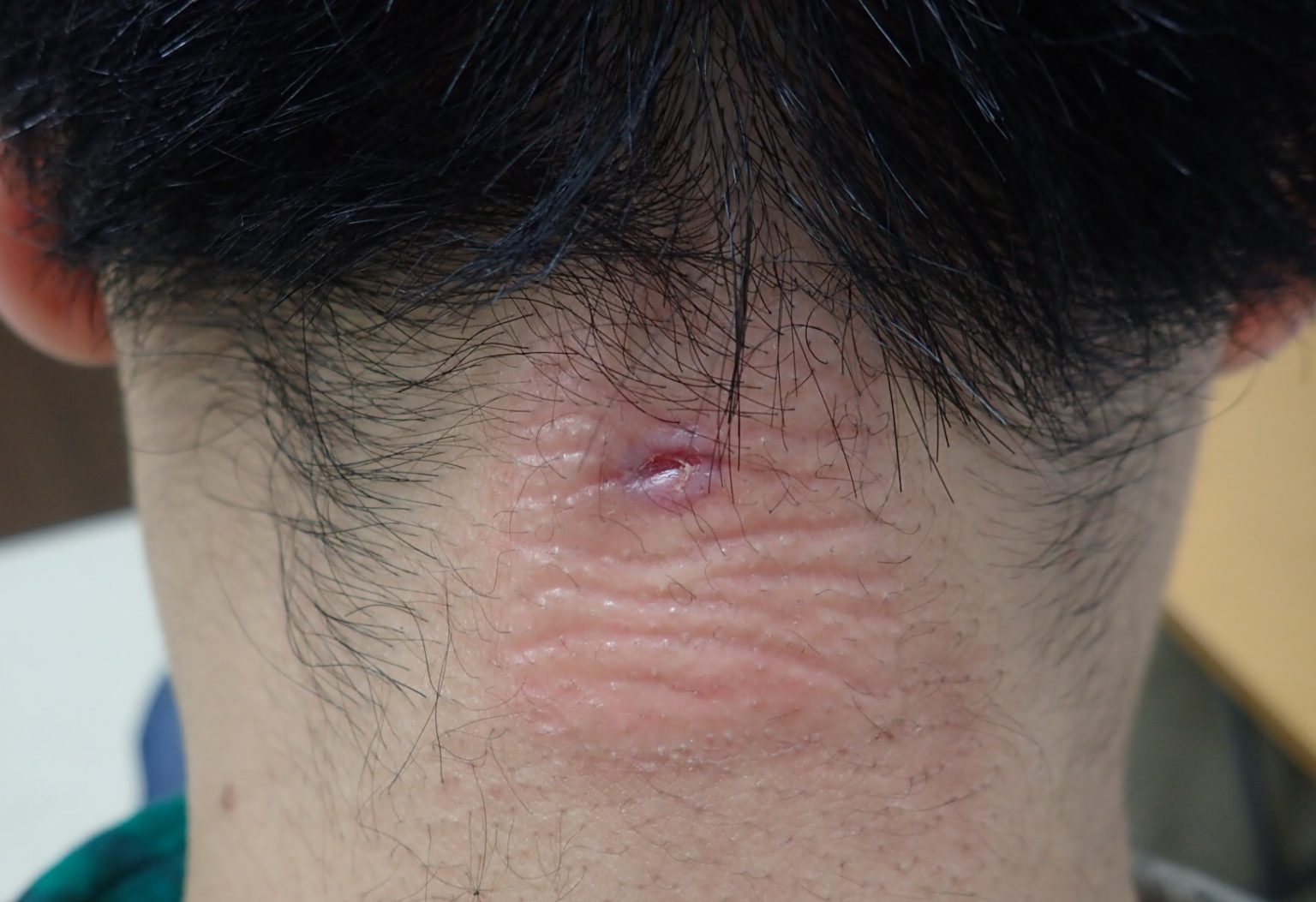 粉瘤 くりぬき法 傷痕 - SSクリニック - 皮膚科・美容外科 - 名古屋市中区