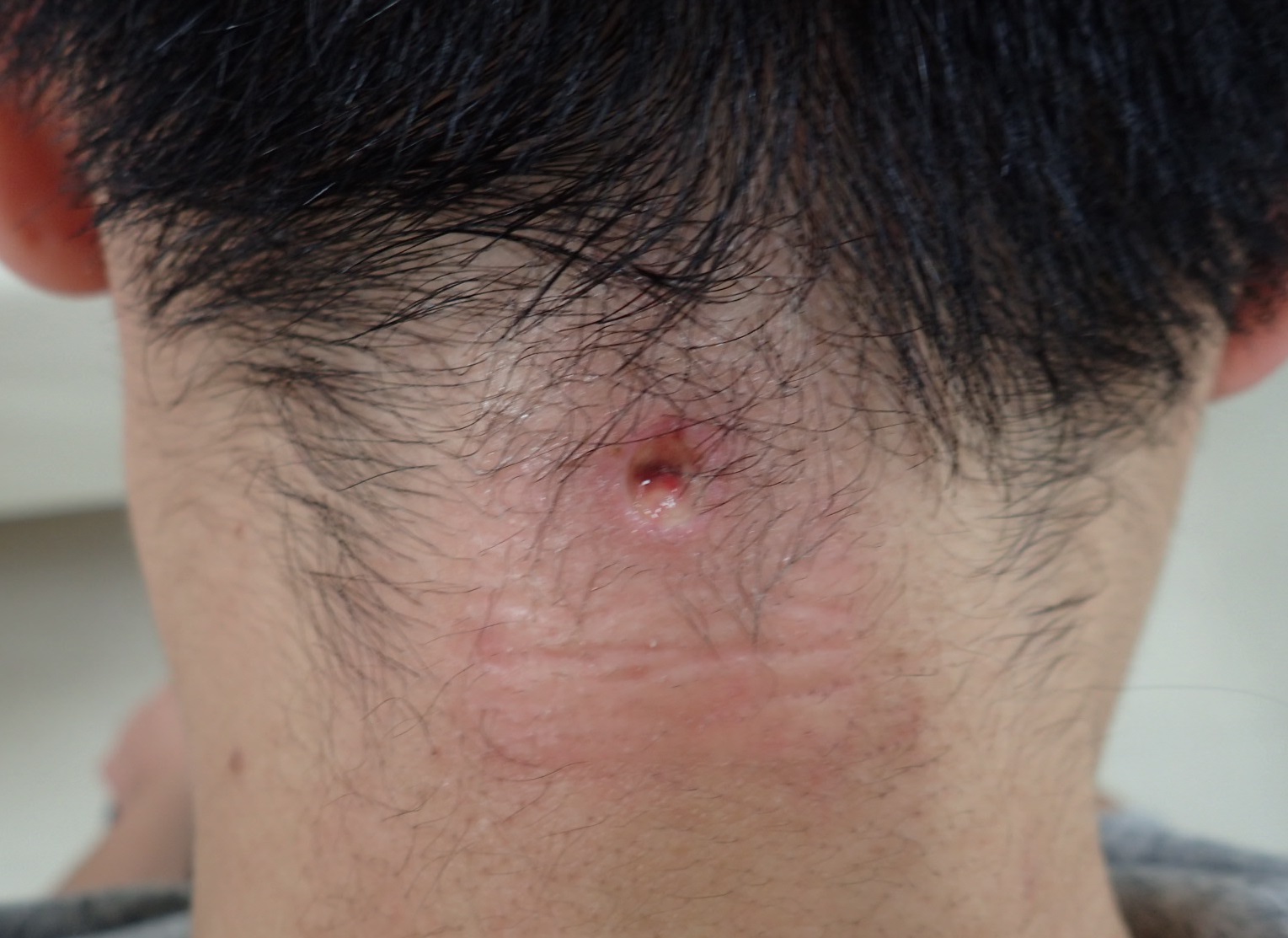 粉瘤 －大きくなる前に－ - SSクリニック - 皮膚科・美容外科 - 名古屋市中区