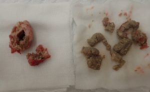 摘出された粉瘤(左,袋・右,内容物)