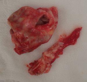 摘出された粉瘤被膜