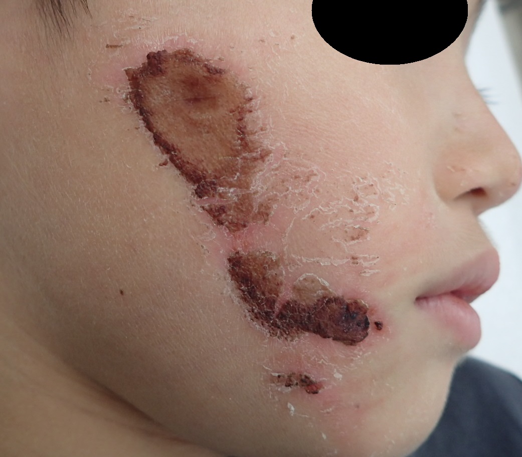 8歳児の顔の擦り傷の初診時