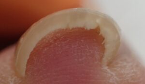 術前(正面)1