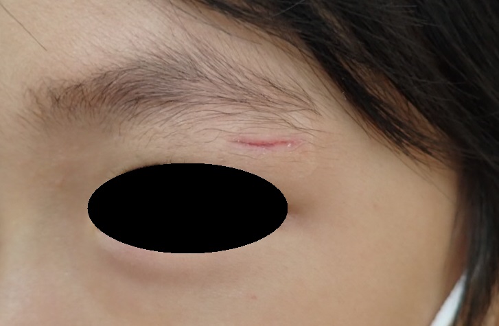 挫創(けが)でまぶたを負傷したお子様|湿潤療法で傷跡を残さず綺麗に治癒した症例 - 粉瘤(アテローム) | こおりたひろ整形形成外科クリニック ...