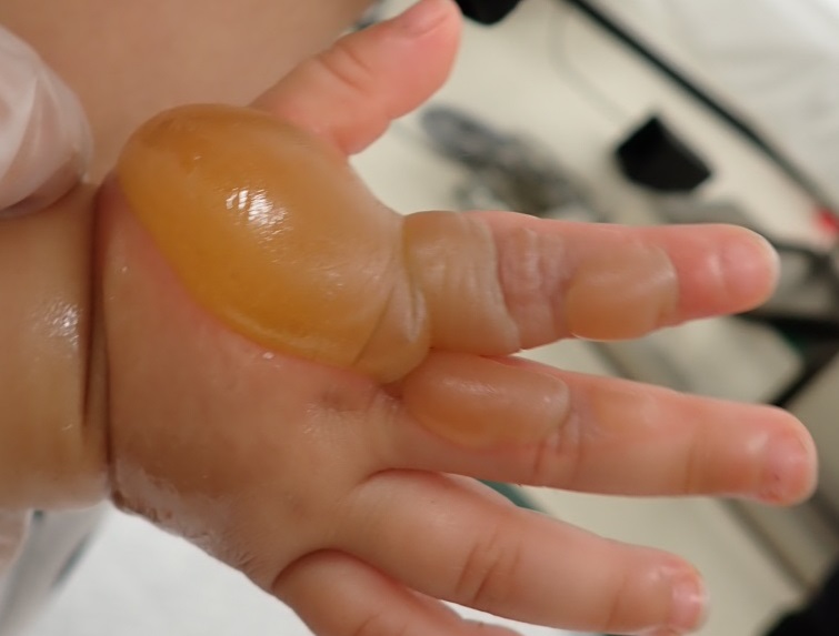1歳児の手のやけどの初診時