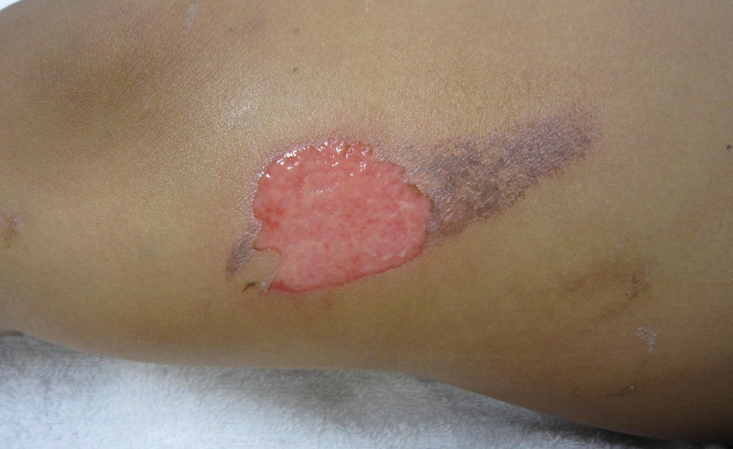 5歳女児の大腿熱傷の初診時
