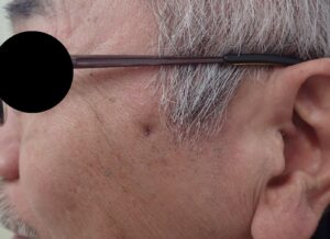 Postoperative Day 12 After Cheek Epidermoid Cyst Removal – No Swelling, Pain, or Infection - 粉瘤(アテローム) | こおりたひろ整形形成外科クリニック - 痛みの少ない粉瘤治療で多数の実績|大阪| 12 days after epidermoid cyst removal on the cheek, healing smoothly with punch excision and moist wound care