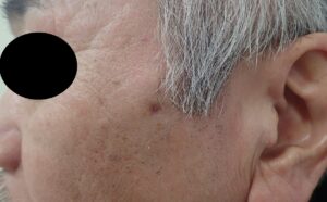 Day 19 After Cheek Epidermoid Cyst Surgery – Healed Scar with Punch Excision & Moist Healing - 粉瘤(アテローム) | こおりたひろ整形形成外科クリニック - 痛みの少ない粉瘤治療で多数の実績|大阪| Postoperative day 19 after punch excision of cheek epidermoid cyst. Wound is nearly flat, with no pain or infection.